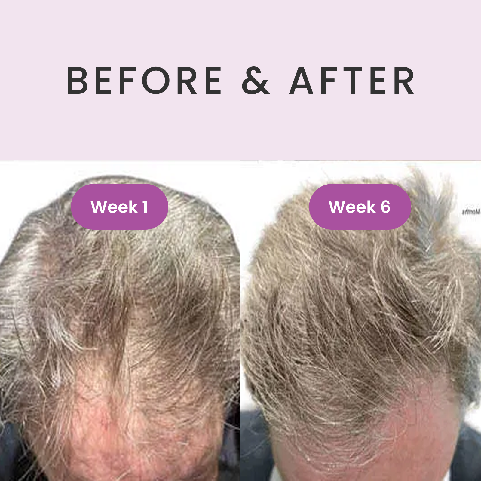 RevivHair Max Hair Stimulating Serum - Now 5% Maximum Strength