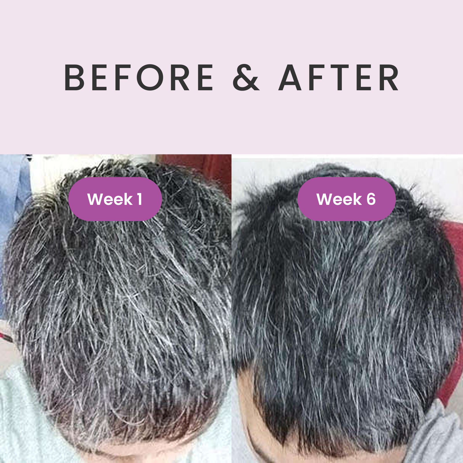 RevivHair REV Advanced with Grey Hair Reverse MelanoGray + Greyverse + Darkenyl RevivSerums.com RevivHair REV Advanced with Grey Hair Reverse MelanoGray + Greyverse + Darkenyl RevivSerums.com